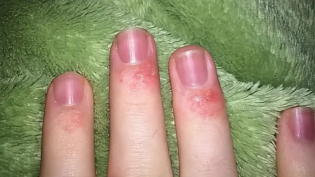 Сыпь вокруг ногтей Сыпь вокруг ногтей